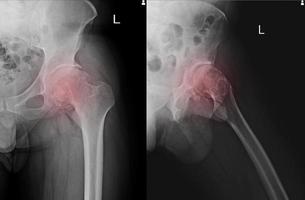 Sklerose der Gelenkfläche des Acetabulums mit Randosteophyten. Osteom am oberen und unteren Rand des Femurkopfes. verkalkte lose Körper im Gelenkspalt. foto