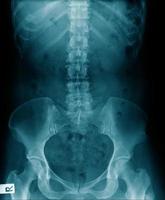 Röntgenthorako-lumbale menschliche Struktur mit Beckenknochen foto