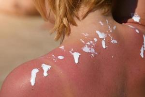 Frau reibt Sonnencreme auf seiner Schulter. vor dem Hintergrund des Meeres. foto