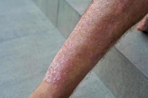 Psoriasis konzentriert sich auf das Bein eines Mannes, Nahaufnahme foto