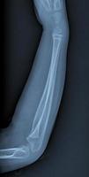 gebrochener arm röntgen foto