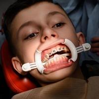 weißer Retraktor an den Lippen und Anbringen von Metallspangen an den oberen Zähnen des Teenagers. foto