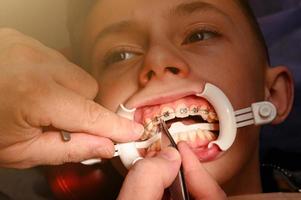 Der Teenager hat eine Zahnspange, die an seine oberen Zähne geklebt ist, um sie zu begradigen, und der Junge hat einen Retraktor an den Lippen. foto