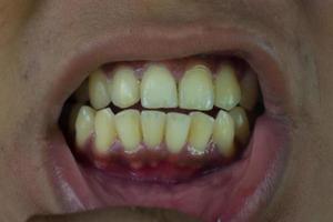 Die Zähne eines Mannes sind gelb foto