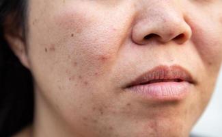 Probleme der Gesichtshaut sind Akne und Hautunreinheiten. foto