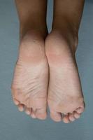Nahaufnahme von Peeling und rissigem Fuß. Zu den Ursachen für das Peeling des Fußes gehörte das Gesundheitskonzept für Pilzinfektionen. foto