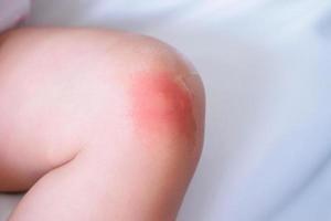 Babyhautausschlag und Allergie mit rotem Fleck, verursacht durch Mückenstich am Knie foto