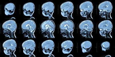 MRT-Scan des menschlichen Schädels und Gehirns, mit Fehlbildungen des Gehirns, vorläufige Diagnose, Holoproenzephalie, Fehlen, Agenesie des transparenten Septums, einjähriger Junge, Seitenansicht. foto