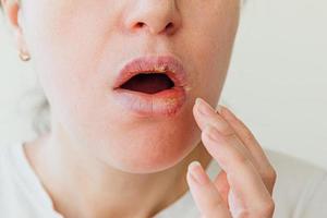 Nahaufnahme von Mädchenlippen, die von Herpes betroffen sind. Behandlung von Herpesinfektionen und -viren. Teil des Gesichts einer jungen Frau mit dem Finger, der Schmerzen auf den Lippen mit Herpes berührt. Beauty-Dermatologie-Konzept. foto