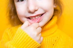 Mädchen zeigt ihre Zähne - pathologischer Biss, Malokklusion, Überbiss. Kinderzahnheilkunde und Parodontologie, Bisskorrektur. Gesundheit und Pflege von Zähnen, Kariesbehandlung, Milchzähne. Oberkiefer ruht auf Zahnfleisch. foto
