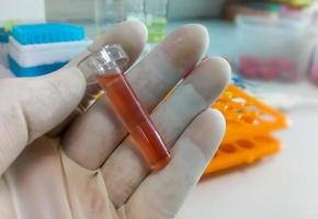 Biochemiker halten Pleuraflüssigkeitsprobe mit Laborhintergrund, die für biochemische Tests bereit ist, einschließlich Glukose, Protein, Ada. Pleuraerguss foto