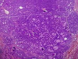 Schilddrüsenkrebs, mikroskopisches Bild eines metastasierten papillären Karzinoms der Schilddrüse, zentraler Lymphknoten. foto