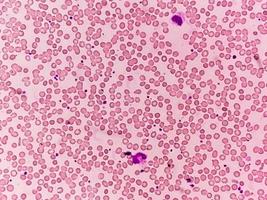 Mikrofotografie oder mikroskopisches Bild, das das Hämoglobin-d-Merkmal mit Eisenmangelanämie zeigt. foto