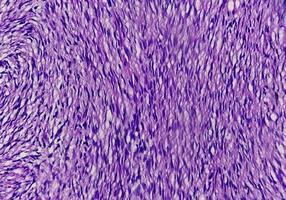 Mikrophotographie eines Schwannoms, eines gutartigen Weichteiltumors der peripheren Nervenscheide. foto