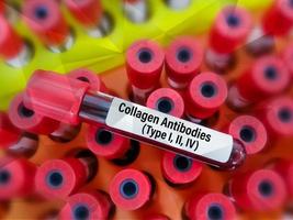 Blutprobe für Kollagen-Antikörper, einschließlich i-, ii- und iv-Test, um eine Lebererkrankung zu diagnostizieren. foto