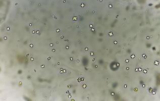 Calciumoxalatkristall aus Urinsediment. foto