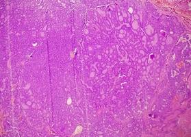 Schilddrüsenkrebs, mikroskopisches Bild eines metastasierten papillären Karzinoms der Schilddrüse, zentraler Lymphknoten. foto