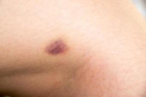 Geschlossen von Blutergüssen auf dem Beinhintergrund der Frau foto