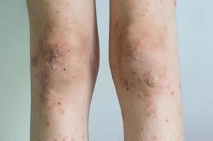 roter Hautausschlag Mädchen Hautkrankheit verursacht durch Allergien gegen Medikamente, Lebensmittel, Chemikalien, schwaches Immunsystem in der Lymphe. foto