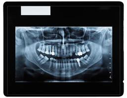 Orthopantomograph Panoramabild Röntgenaufnahme der Zähne foto