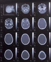Nahaufnahme eines CT-Scans mit Gehirn foto