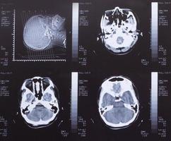 Nahaufnahme eines CT-Scans mit Gehirn foto
