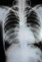 Röntgenbild der menschlichen Brust