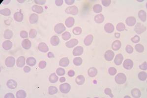 Blutausstrich Beta-Thalassämien (î² Thalassämien) sind eine Gruppe von foto