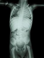 Film Röntgen Ganzkörper des Kindes foto