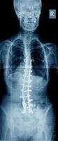 Skoliose-Röntgenbild mit Implantat foto