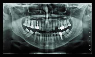 Orthopantomograph Panoramabild Röntgenaufnahme der Zähne foto