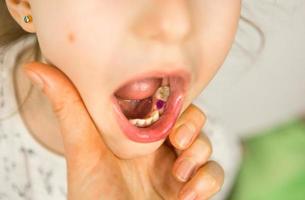 farbige violette Füllung auf dem Milchkauzahn des Mädchens. Kinderzahnheilkunde, Behandlung und Untersuchung. Ein Kind mit offenem Mund zeigt einen Zahn in Nahaufnahme auf weißem Hintergrund. foto