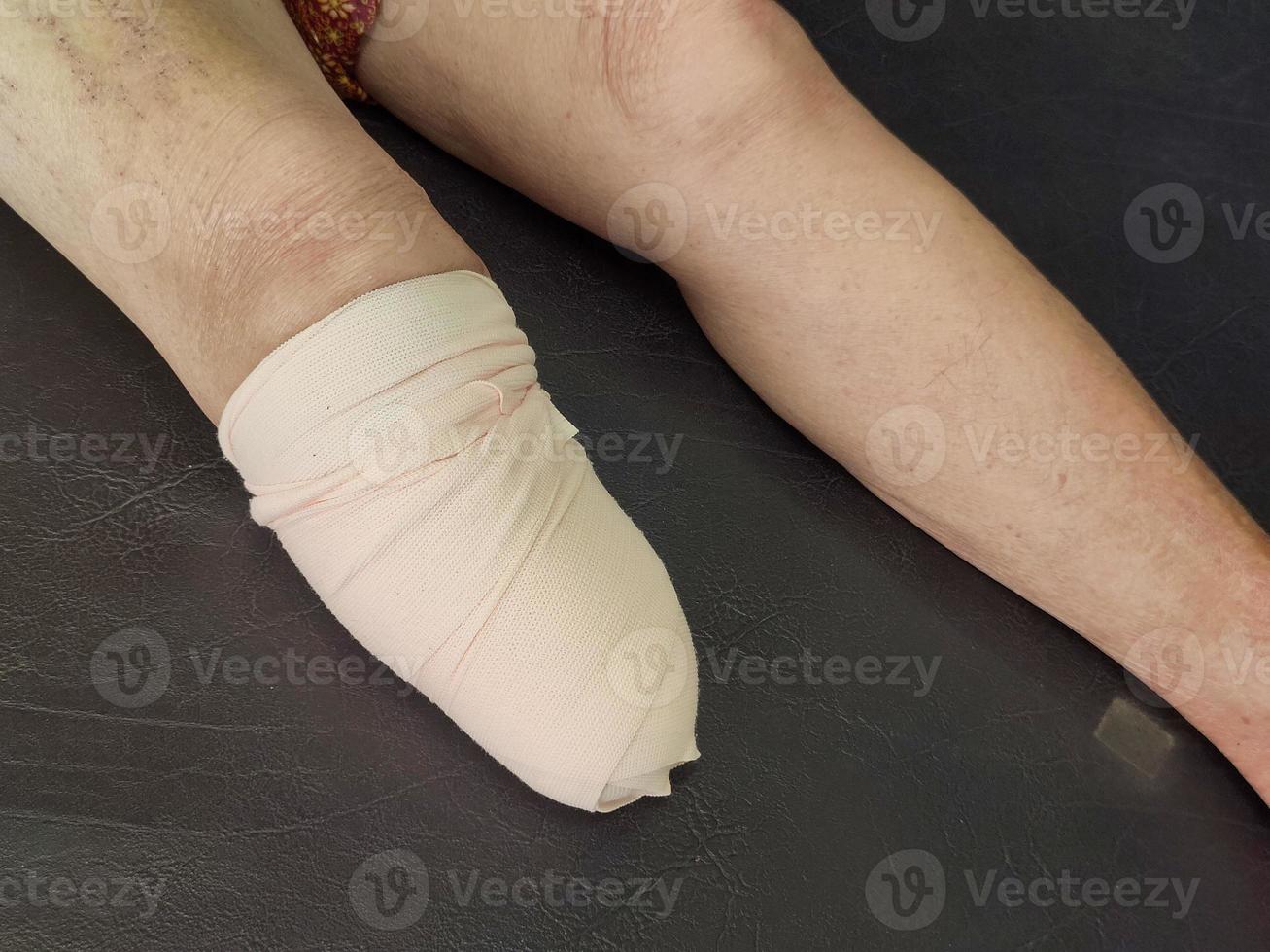 Nedan knä amputation bandage för bk protes. foto