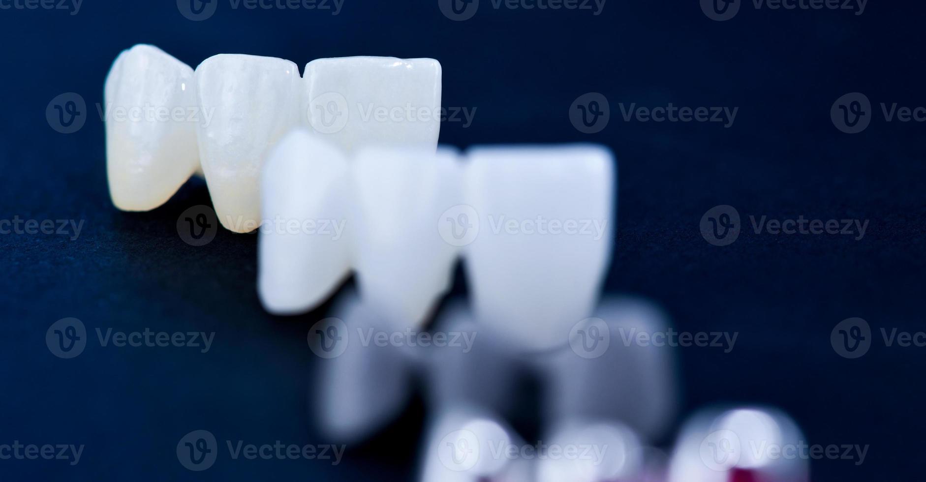 annorlunda typer av dental tand kronor foto