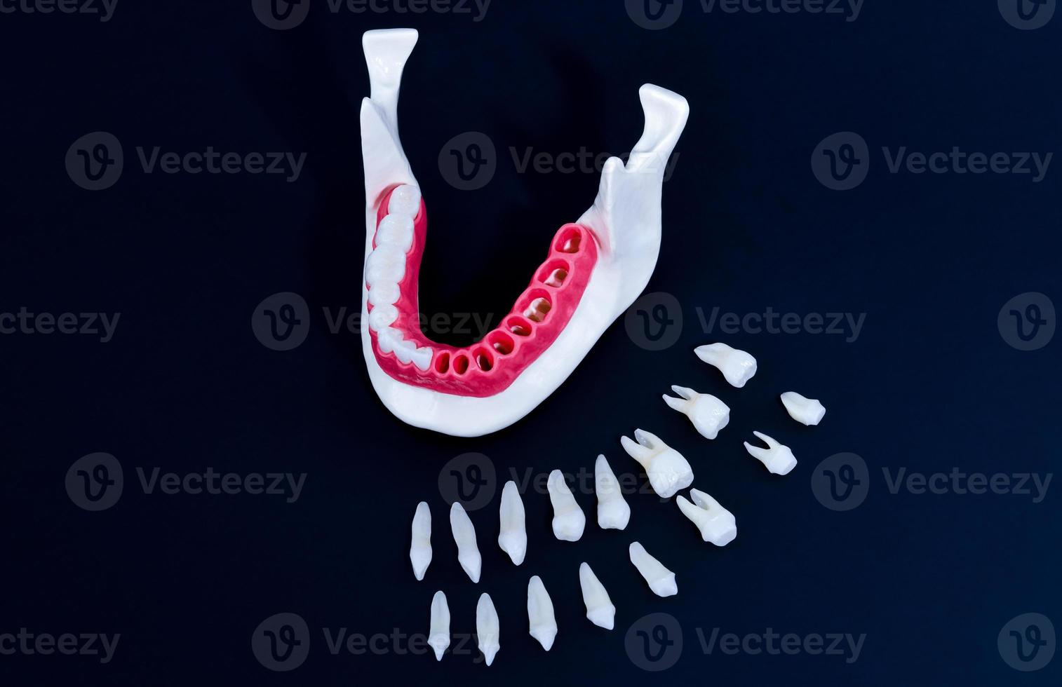 tand implantera och krona installation bearbeta foto