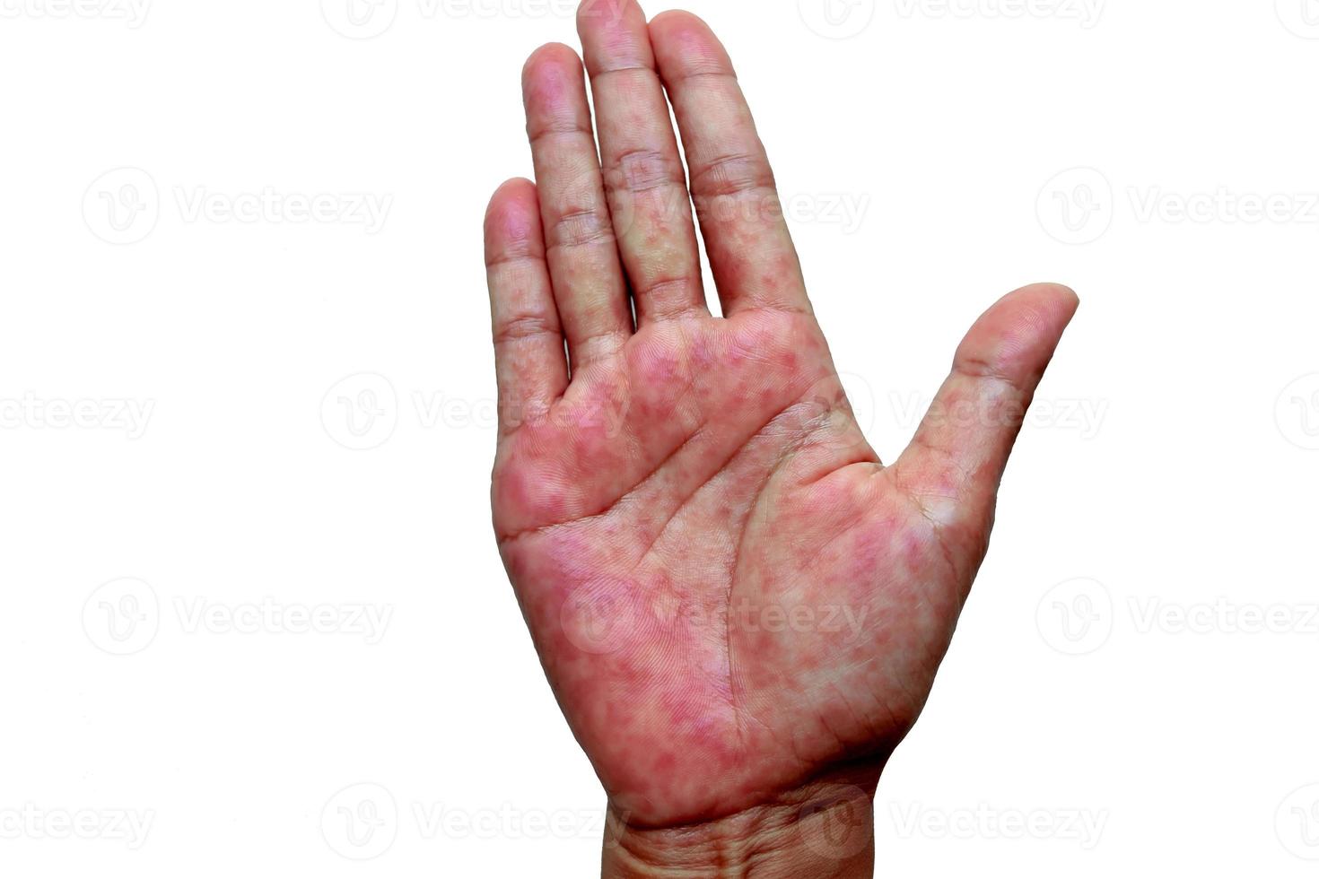 atopisk dermatit också känd som atopisk eksem är en typ av inflammation av de hud på händer foto