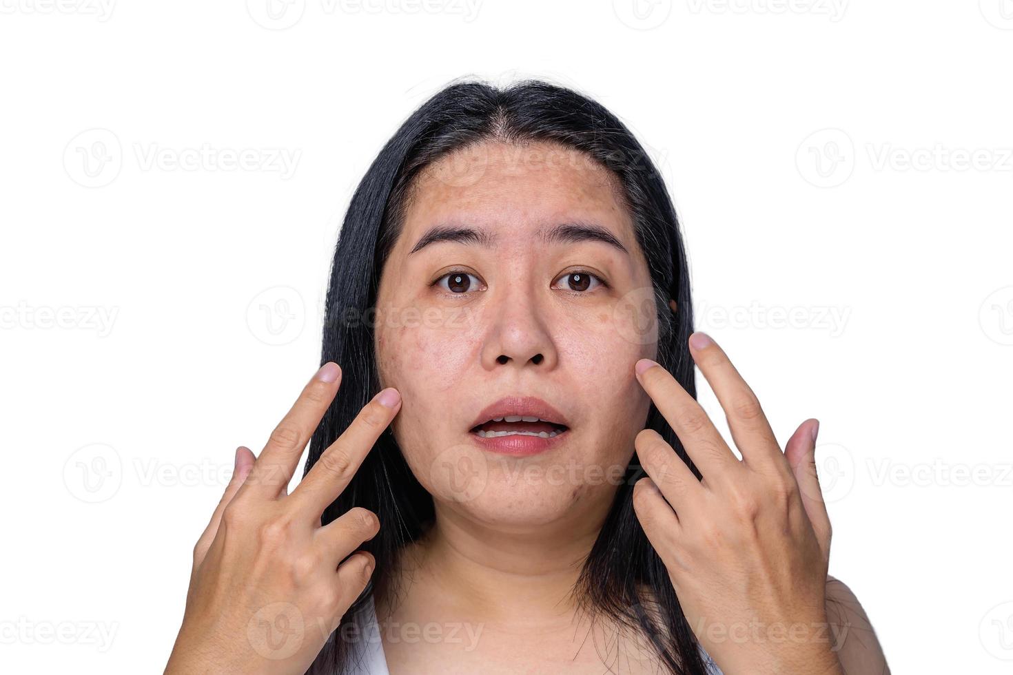 asiatisk vuxen kvinna ansikte har fräknar, stor porer, pormask finne och ärr problem från inte ta vård för en lång tid. hud problem ansikte isolerat vit bakgrund. behandling och hudvård begrepp foto