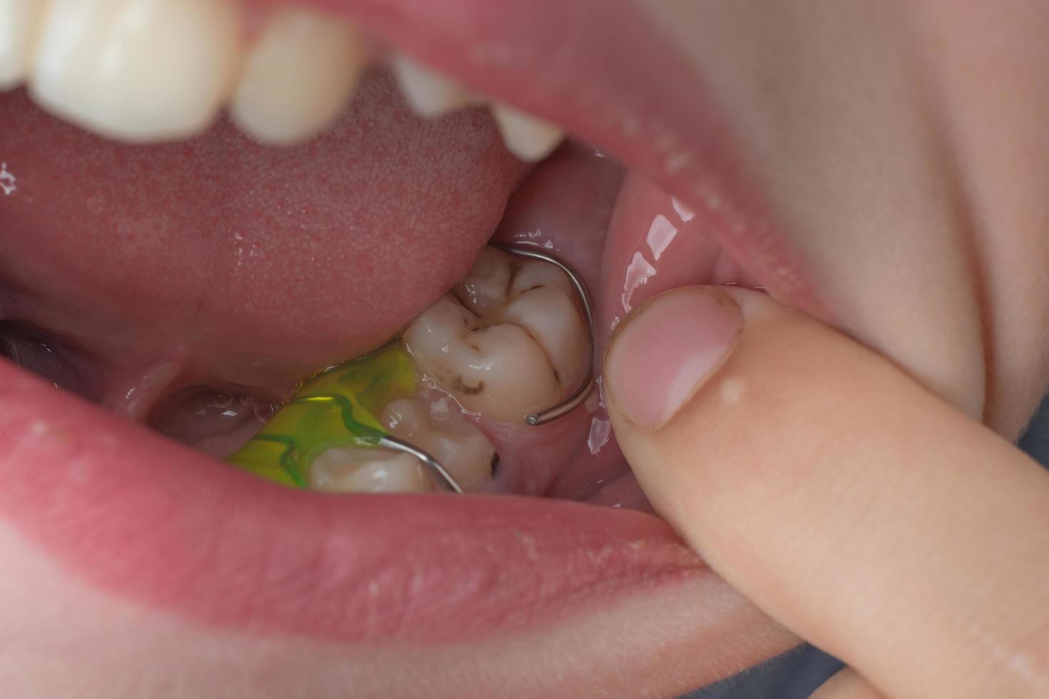 mandibular tallrik, en pojke bär en tallrik till justera hans tänder. foto