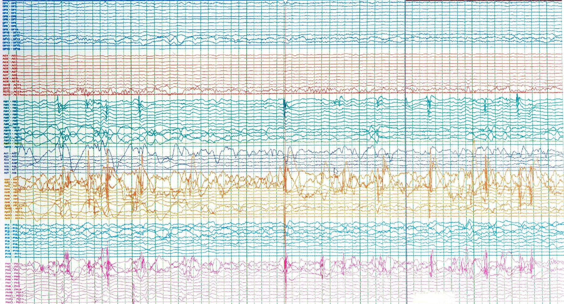 fotografi av hjärna vågor av epileptisk patient som visar skarp Vinka under Nej beslag eller interiktal eeg. foto