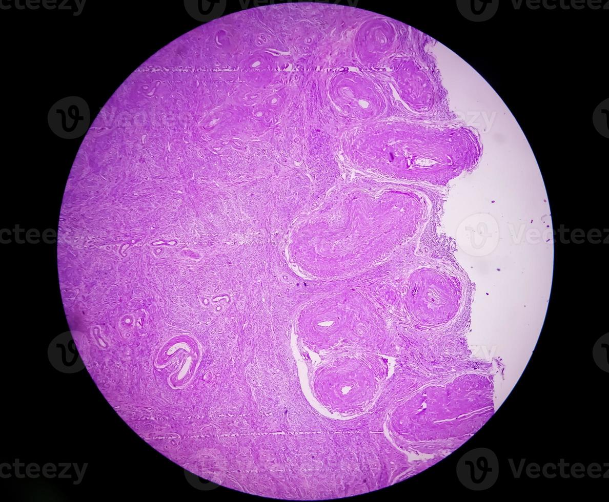 histologisk undersökning av livmoder biopsi suggestivt uterin framfall. kronisk cervicit med framfall. foto