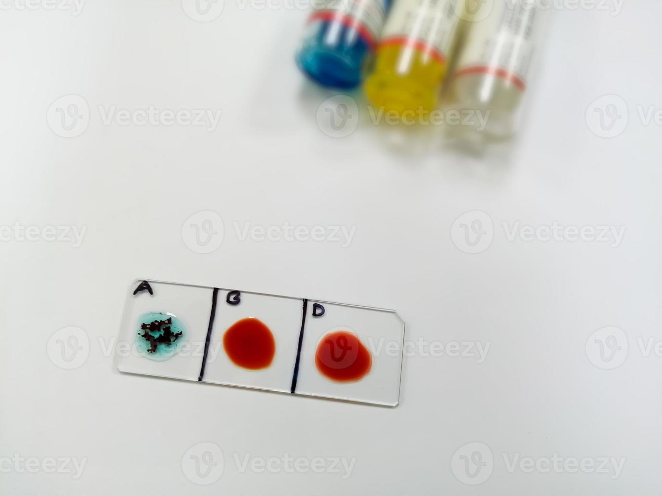 en negativ blod typ, ett av de sällsynt blod grupp i över hela världen. blod grupp och rh faktor testning förbi glida agglutination metod. foto