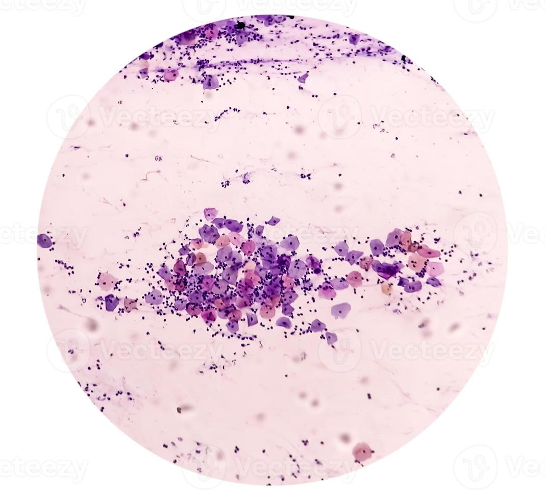 mikroskopisk se av pappas smeta som visar svår negativ för intraepitelial lesion malignitet eller nilm. cervical cancer diagnos. foto