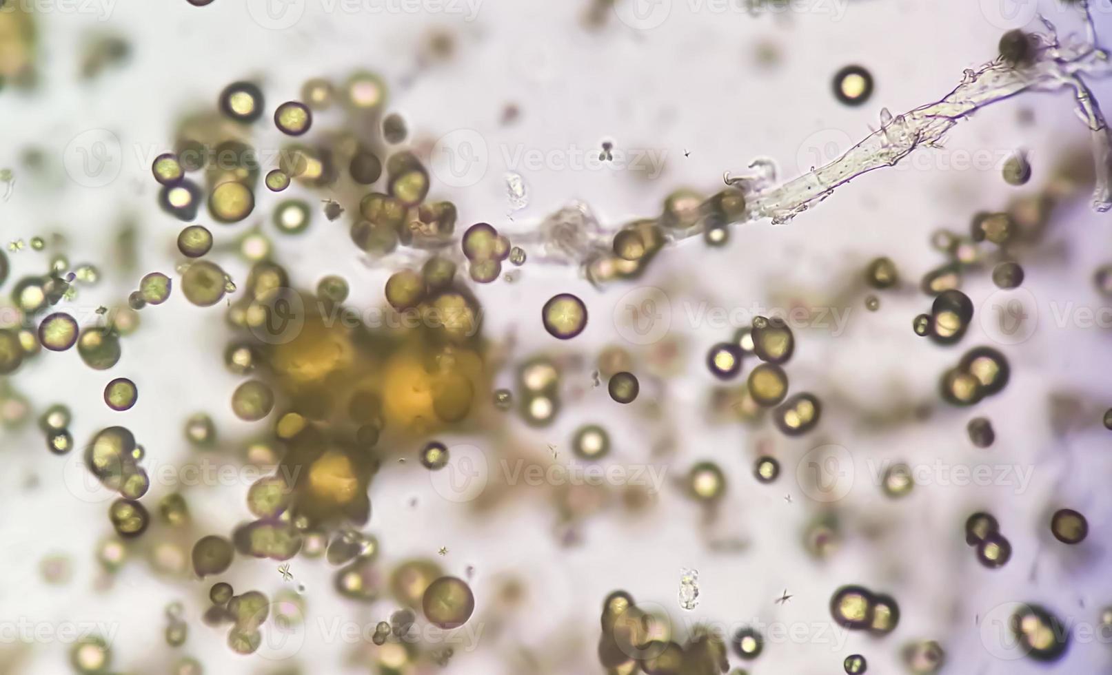 mikroskopisk bild av urinprov. onormal urin examen. urin syra kristaller. foto