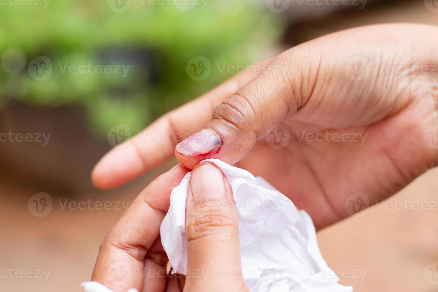 skada till de rätt hand nagel och blödning till de rätt tumme och orsakar blödning i de nagel foto