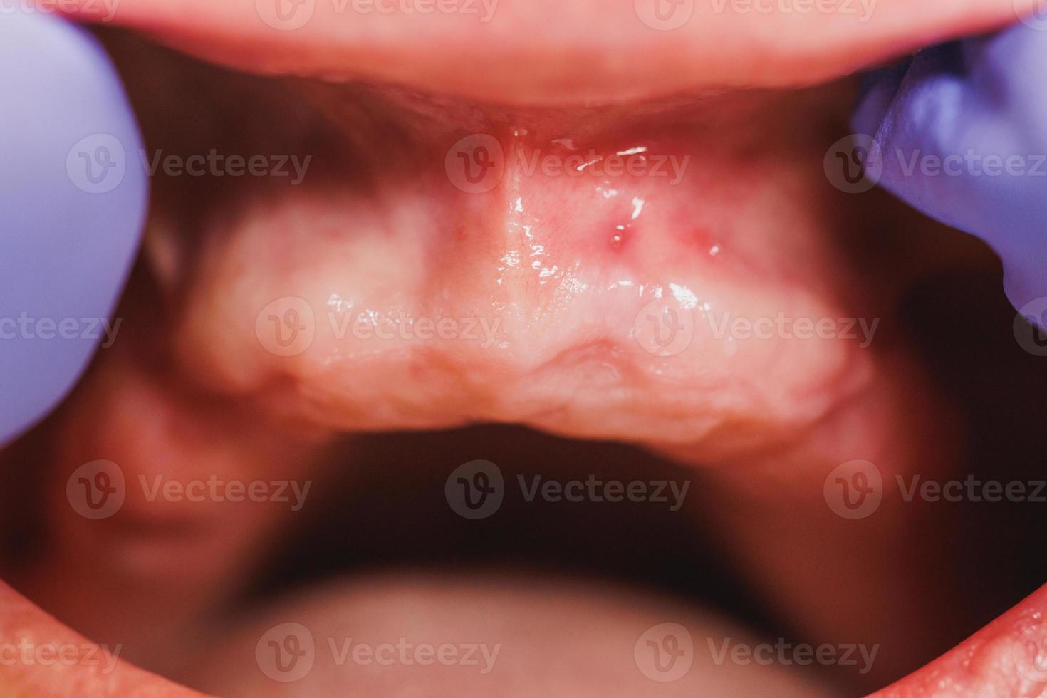 närbild av en dental processer av implantation av tänder till en patient foto