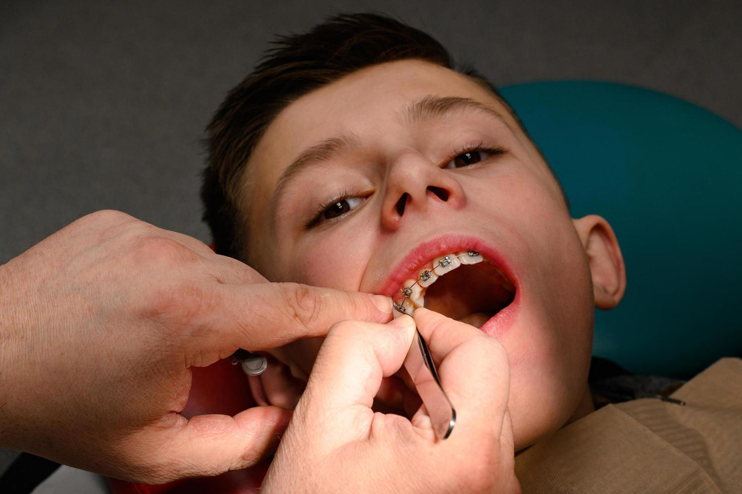 ett ortodontist lim och fäster tandställning på de övre tänder av en skolpojke, inriktning tänder med tandställning. foto
