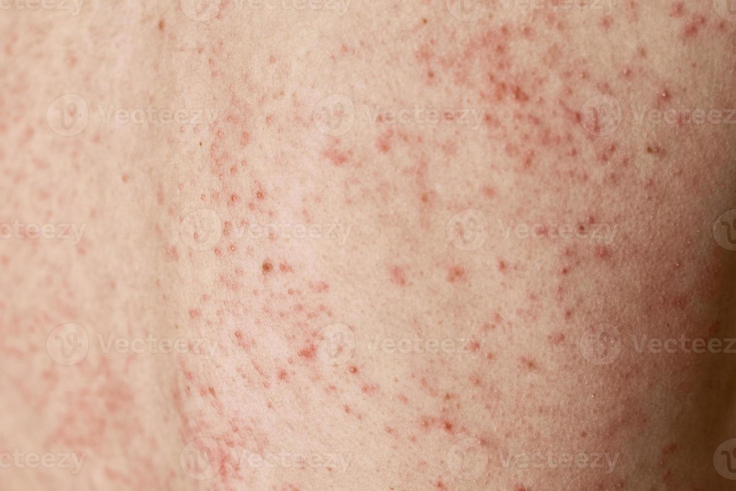 allergisk utslag på hud. kvinna med dermatologi problem på tillbaka hud foto