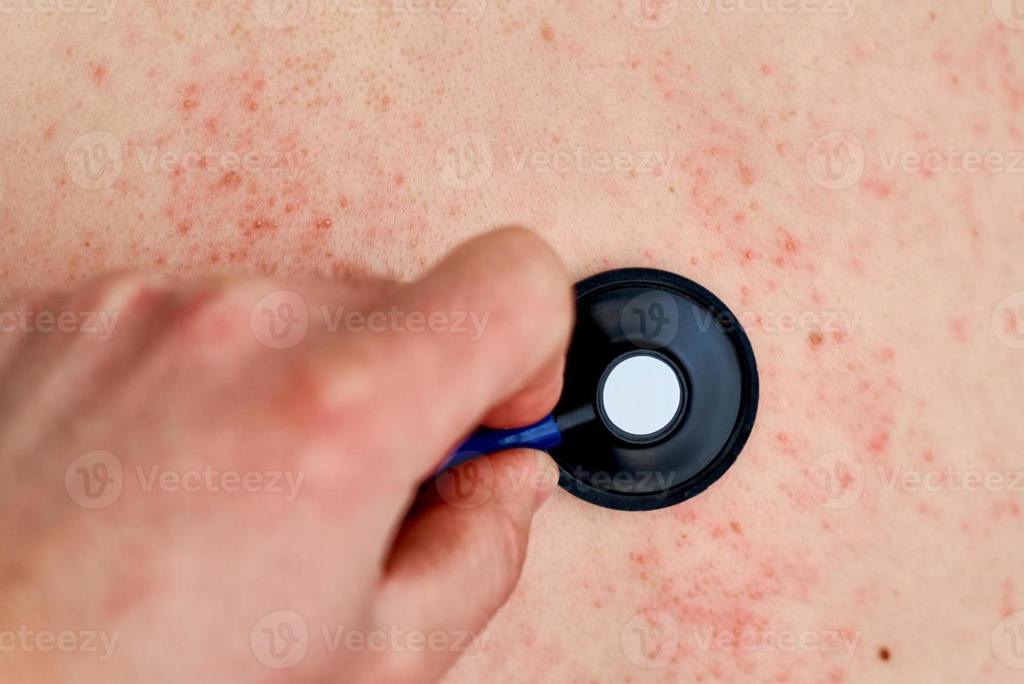 allergisk utslag på hud. kvinna med dermatologi problem på tillbaka hud foto