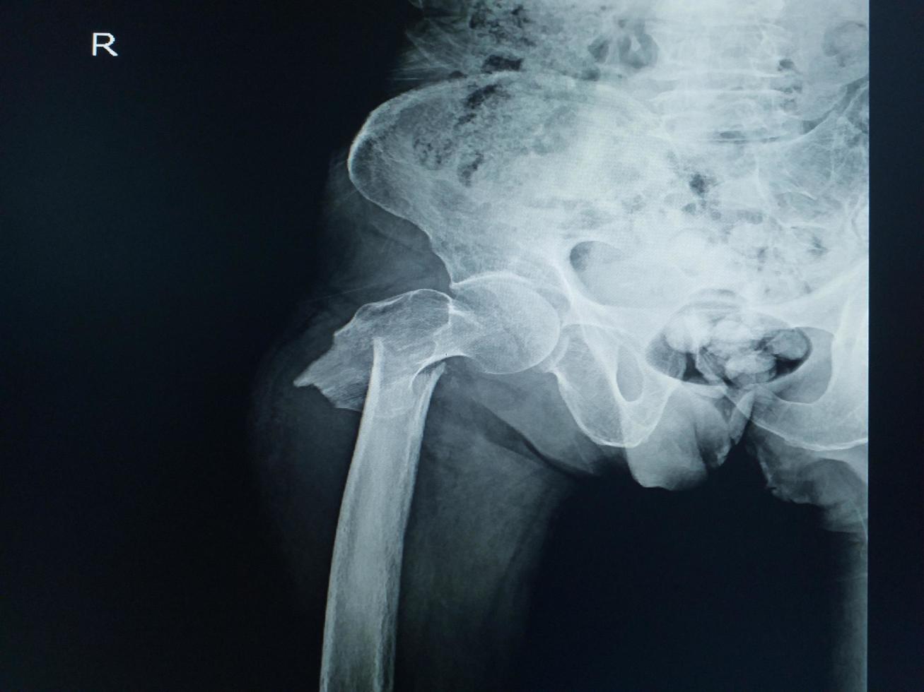 röntgen av de bäcken och lumba och höft fraktur rätt lårben foto