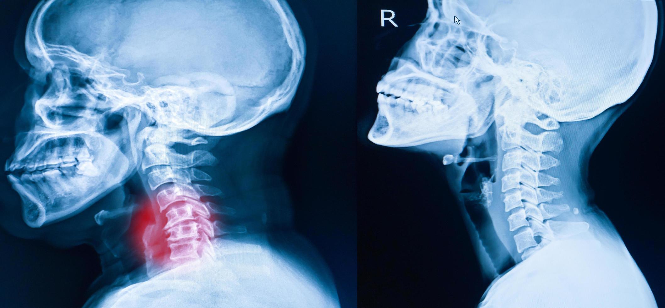 röntgen bild av cervical ryggrad, nacke röntgen bild foto